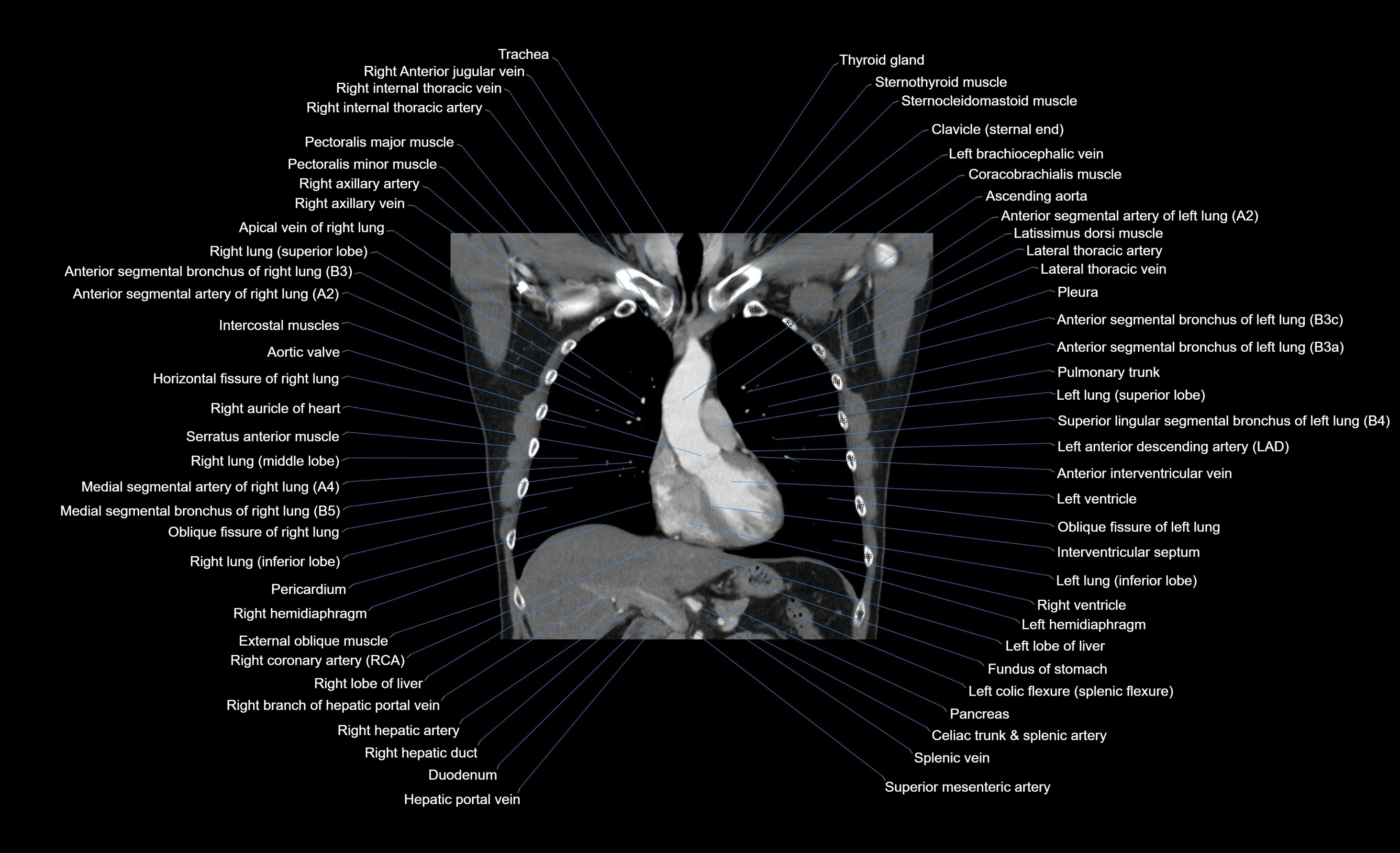 CT chest (thorax) labelled coronal cross sectional anatomy radiology image-00073.webp